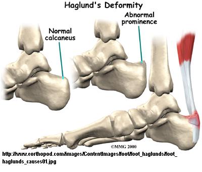 insertional Achilles