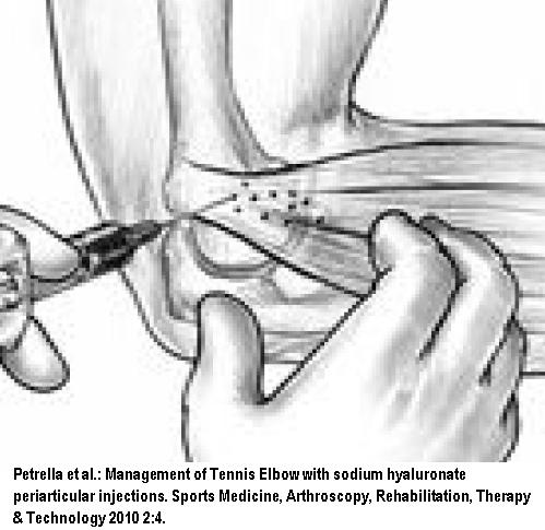 Steroid injection muscle pain