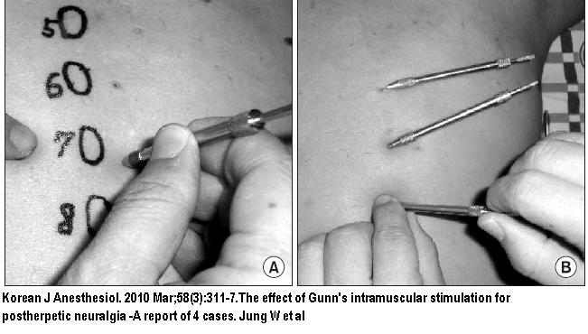 Postherpetic Neuralgia Phn