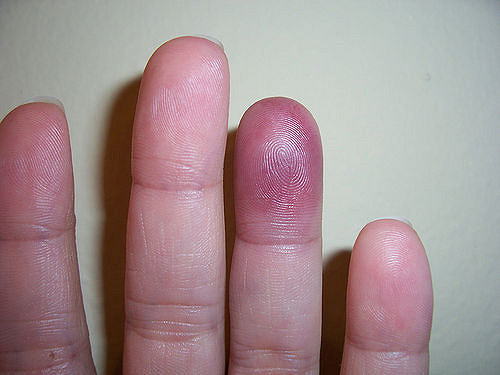 finger-bruising-recurrent-spontaneous-pain-medical-musing