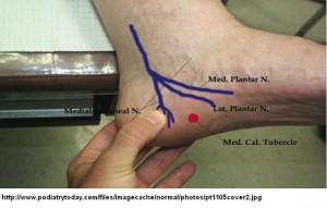 Pain after steroid injection for plantar fasciitis