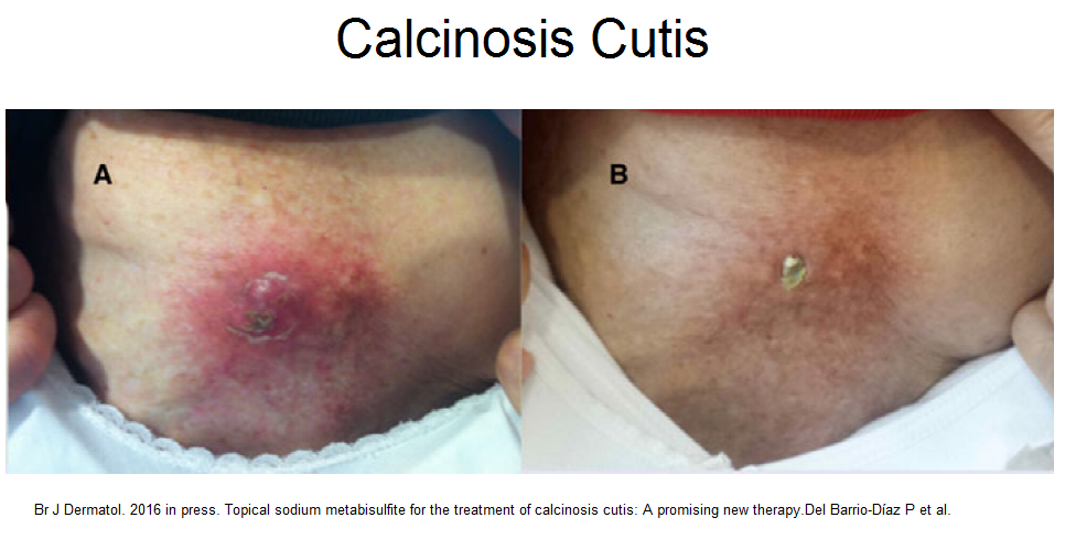 calcinosis cutis #11