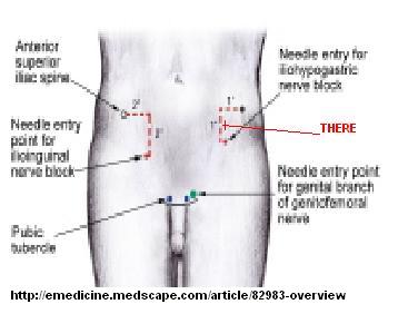 pain hernia neurectomy ilioinguinal iliac spine anterior superior medial inferior cm down surgical cure directed simple