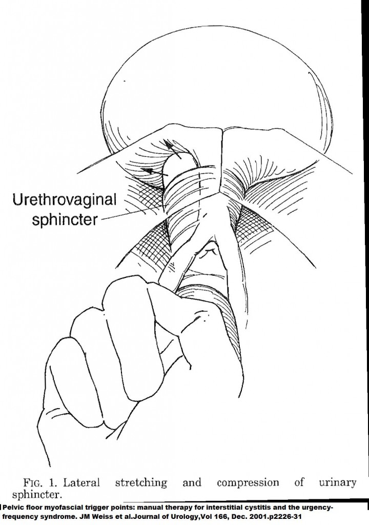 massage cystitis interstitial problem point pain sphincter diagram urinary test syndrome question related al