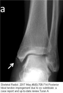 Tip of Medial Malleolus- Possible Posterior Tibialis Tendonitis