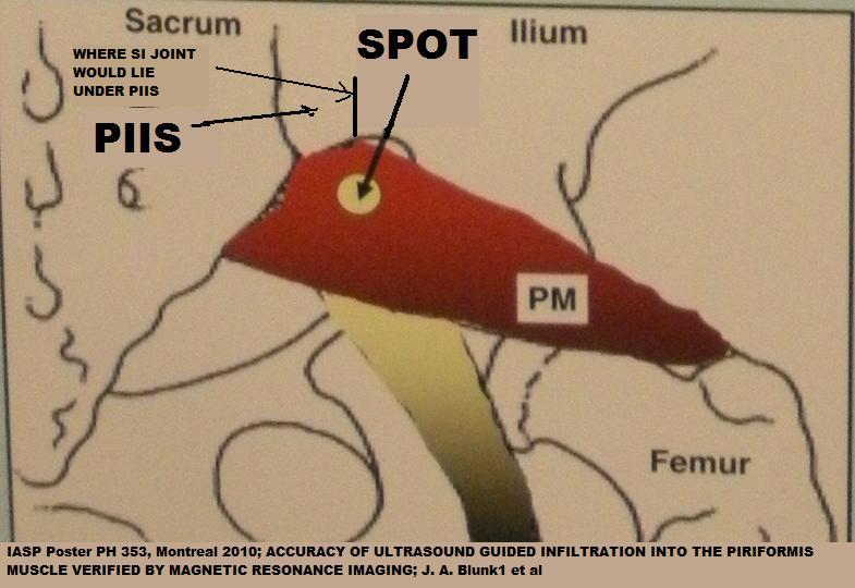 Piriformis Muscle Injection