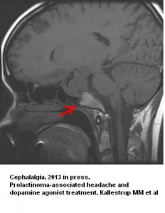 prolactinoma