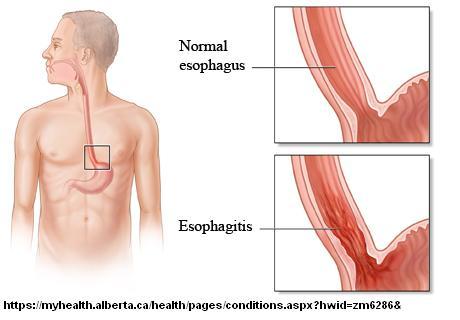  Hypersenstive Esophagus Helped by Citalopram | Pain Medical Musing