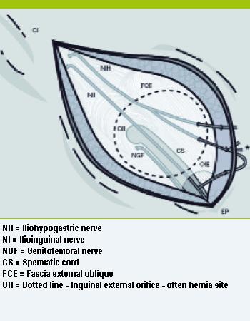 Hernia Surgery Complications Nerve Pain